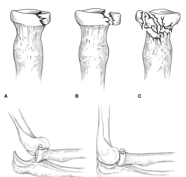 化繁为简，快速牢记上肢骨折常用分类与分型标准！