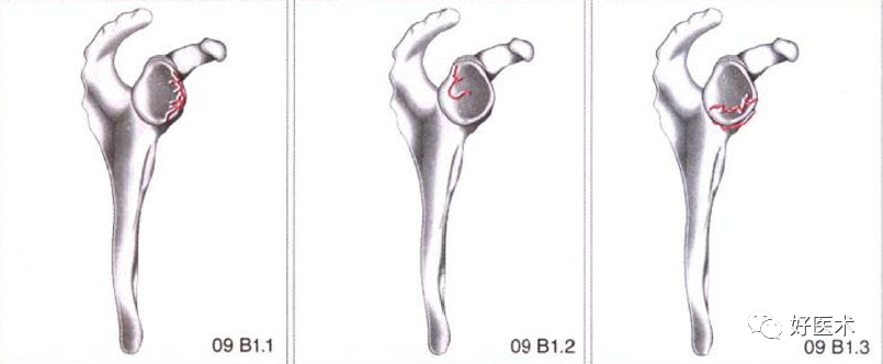 化繁为简，快速牢记上肢骨折常用分类与分型标准！