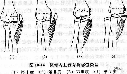 化繁为简，快速牢记上肢骨折常用分类与分型标准！