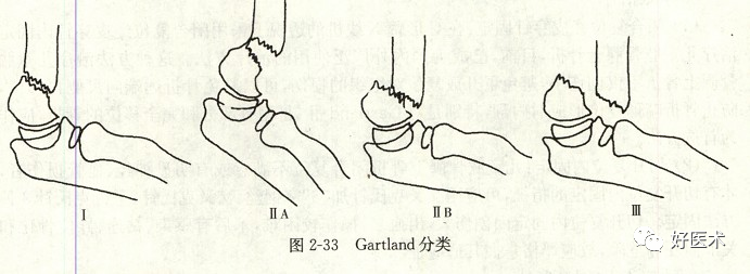 化繁为简，快速牢记上肢骨折常用分类与分型标准！