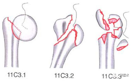 化繁为简，快速牢记上肢骨折常用分类与分型标准！