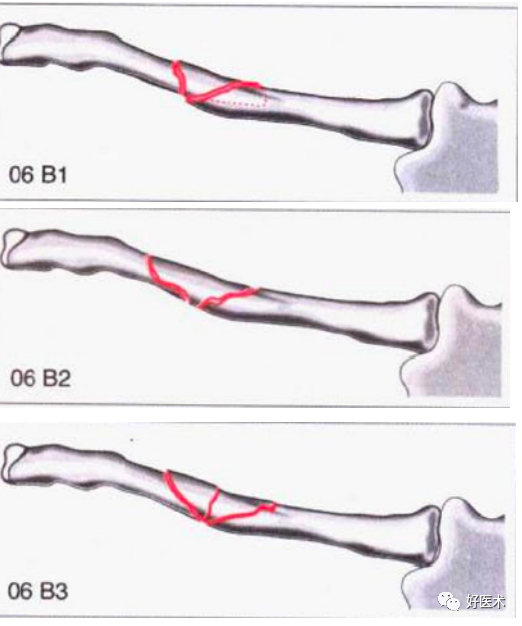 化繁为简，快速牢记上肢骨折常用分类与分型标准！