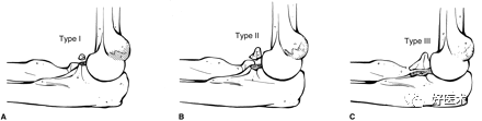化繁为简，快速牢记上肢骨折常用分类与分型标准！
