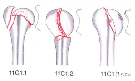 化繁为简，快速牢记上肢骨折常用分类与分型标准！