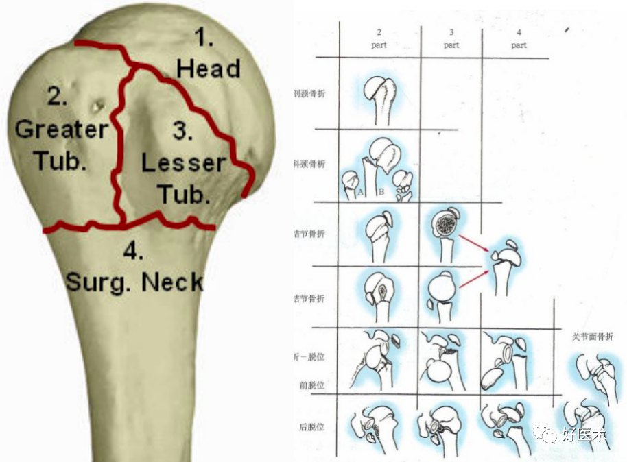 化繁为简，快速牢记上肢骨折常用分类与分型标准！