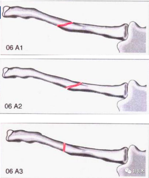化繁为简，快速牢记上肢骨折常用分类与分型标准！