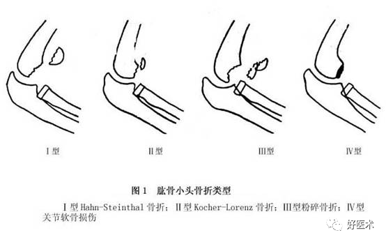 化繁为简，快速牢记上肢骨折常用分类与分型标准！