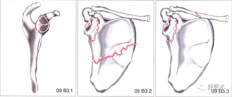 化繁为简，快速牢记上肢骨折常用分类与分型标准！