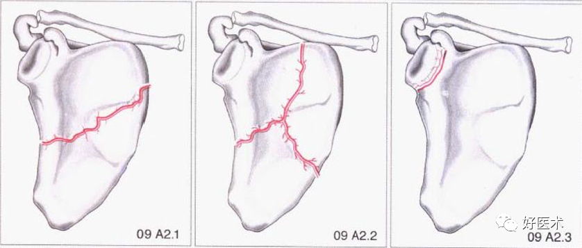 化繁为简，快速牢记上肢骨折常用分类与分型标准！