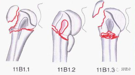 化繁为简，快速牢记上肢骨折常用分类与分型标准！