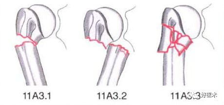 化繁为简，快速牢记上肢骨折常用分类与分型标准！