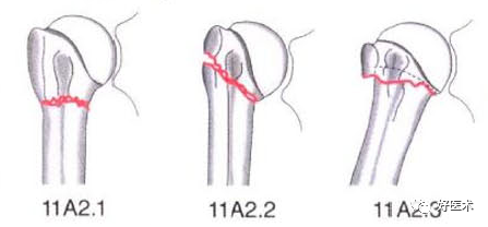 化繁为简，快速牢记上肢骨折常用分类与分型标准！