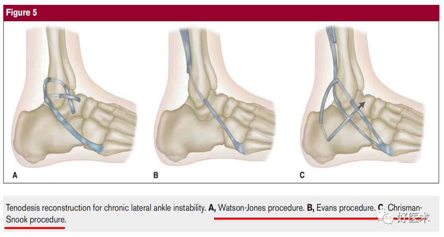 慢性外侧踝关节不稳的处理，速度查看！