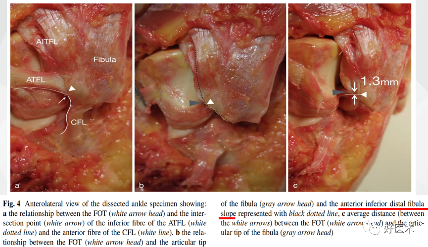 慢性外侧踝关节不稳的处理，速度查看！