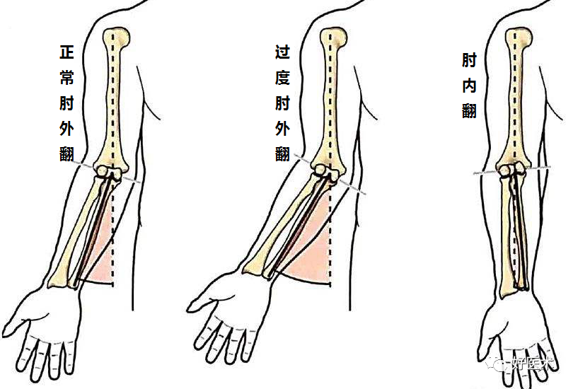 正常肘关节完全伸直时有轻度外翻,使肘关节伸直时前臂远离正中线,增大