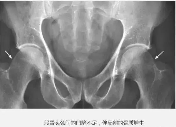 髋关节疼痛新认识：髋关节撞击综合征！