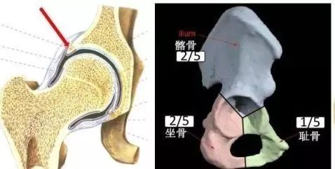 髋关节疼痛新认识：髋关节撞击综合征！