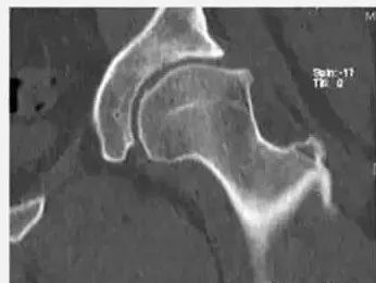 髋关节疼痛新认识：髋关节撞击综合征！