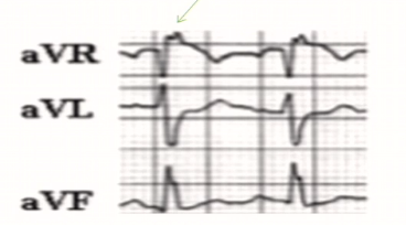 急性肺栓塞的9种心电图表现