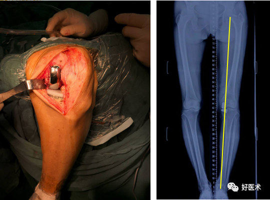 膝关节单髁置换手术，技术要点请收好！