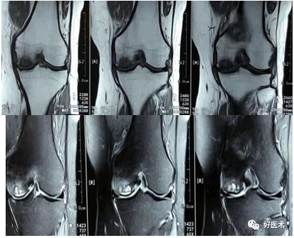 膝关节单髁置换手术，技术要点请收好！
