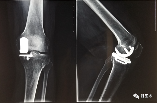膝关节置换手术录像图片