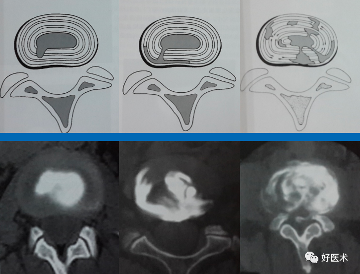 椎间盘退变五大经典MRI征象，全部掌握的很少！