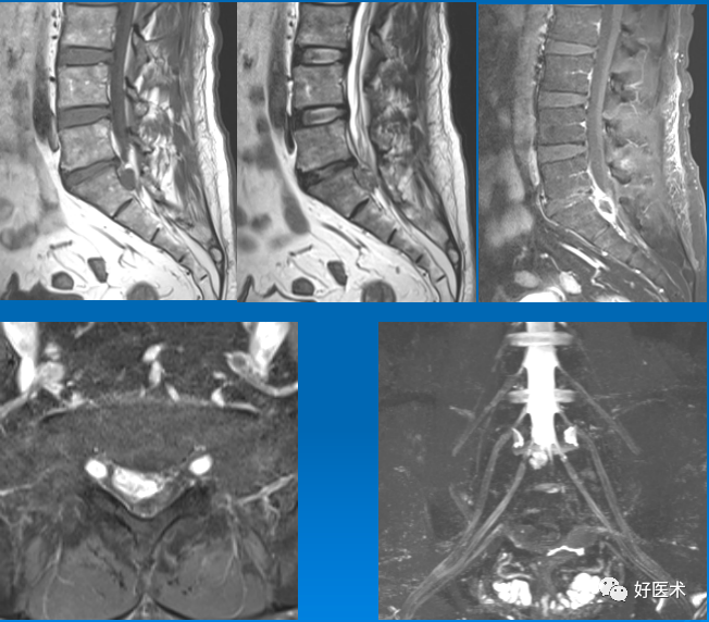 椎间盘退变五大经典MRI征象，全部掌握的很少！
