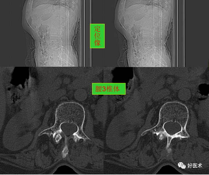 重要发现：这份“无漏洞”的腰部CT为骨科医生敲响警钟！