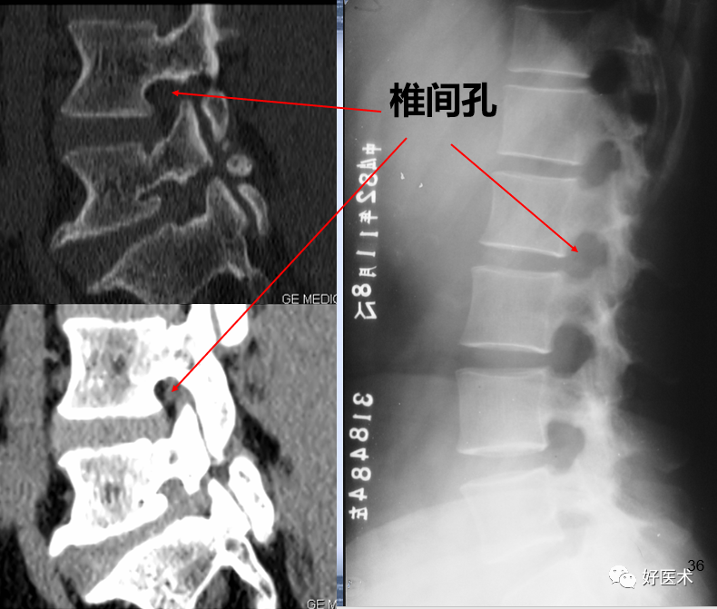 重要发现：这份“无漏洞”的腰部CT为骨科医生敲响警钟！
