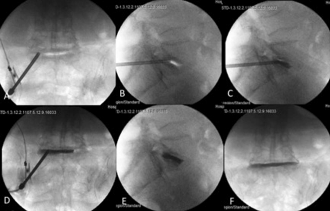 经皮骨水泥椎间盘成形术，本文带你全面了解！