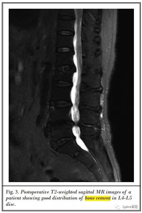 经皮骨水泥椎间盘成形术，本文带你全面了解！