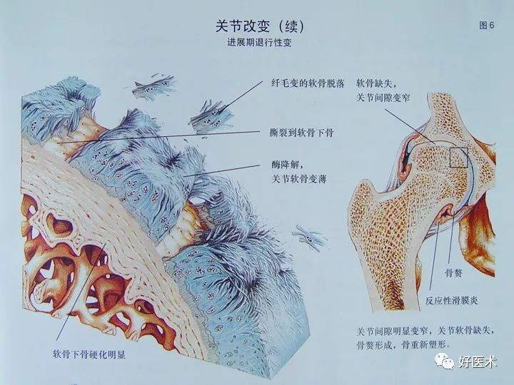 骨关节炎药物怎么选择？这篇文章告诉你答案！