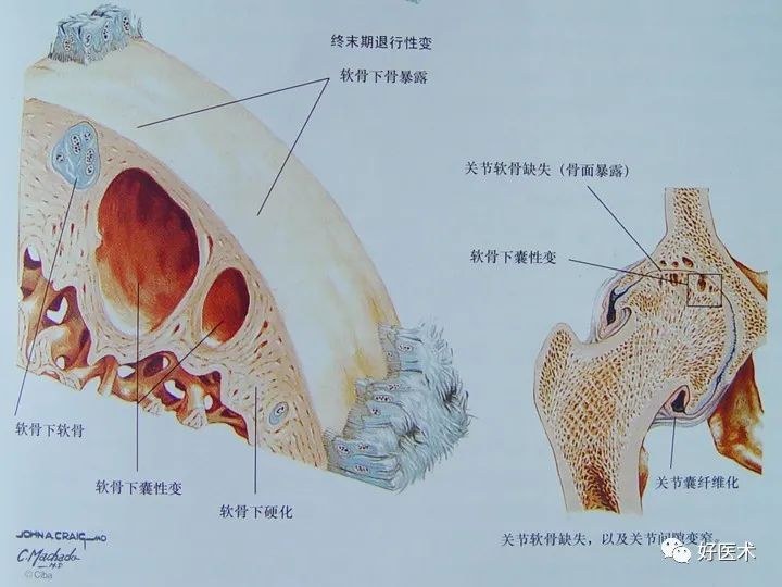 骨关节炎药物怎么选择？这篇文章告诉你答案！