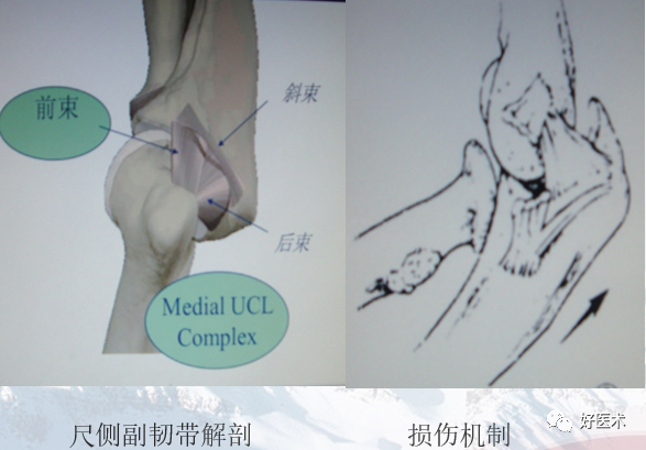 带线锚钉在创伤骨科中的妙用，你掌握了几种？