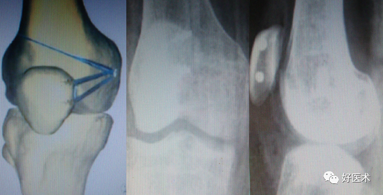 带线锚钉在创伤骨科中的妙用，你掌握了几种？