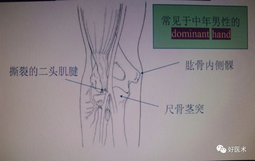 带线锚钉在创伤骨科中的妙用，你掌握了几种？