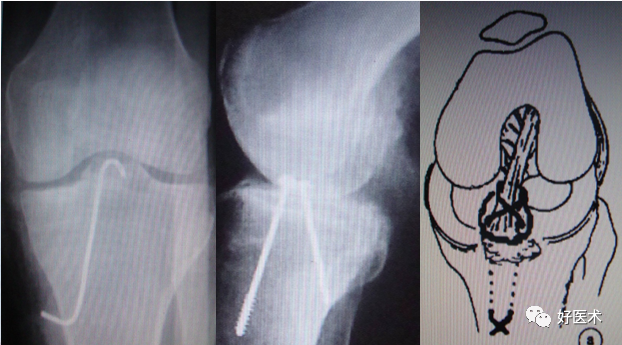 带线锚钉在创伤骨科中的妙用，你掌握了几种？