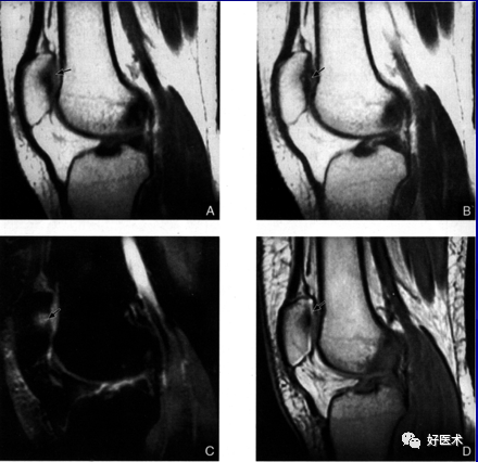 从影像学表现到诊断治疗，全面解析髌骨软化！