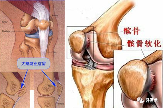 从影像学表现到诊断治疗，全面解析髌骨软化！