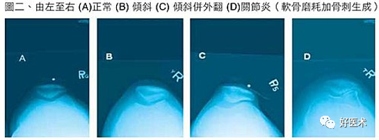 从影像学表现到诊断治疗，全面解析髌骨软化！