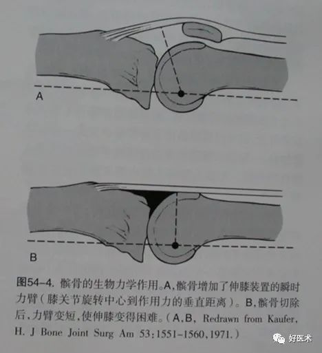 从影像学表现到诊断治疗，全面解析髌骨软化！