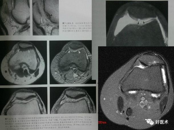 从影像学表现到诊断治疗，全面解析髌骨软化！