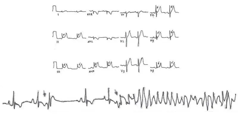 早期复极综合征的三种心电图表现，你都掌握了吗？