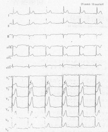 早期复极综合征的三种心电图表现，你都掌握了吗？
