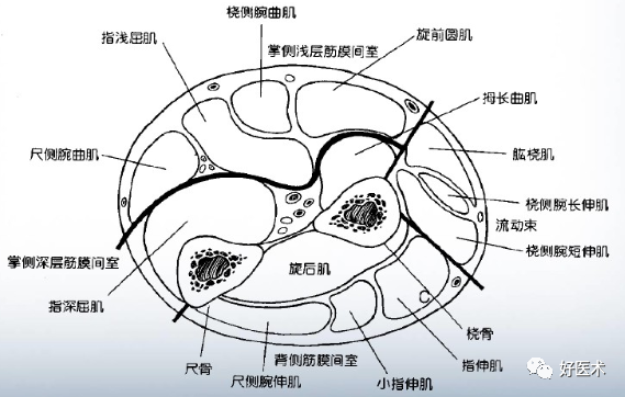 骨筋膜室综合征解剖图图片