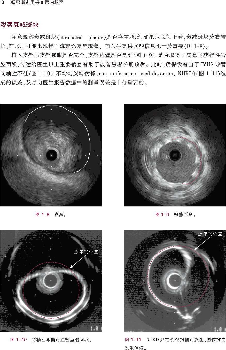 新书首发：用好血管内超声（IVUS），这本书可以教你更多小技巧！