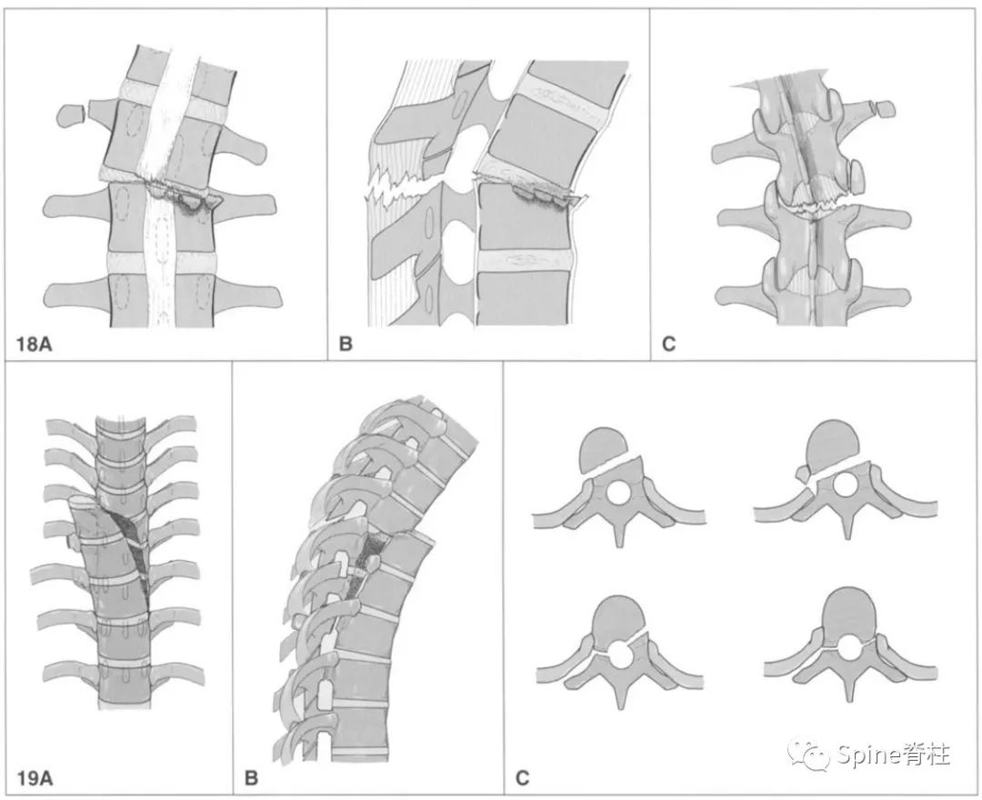 实用骨科基础：胸腰椎骨折的分型与评分，速看！