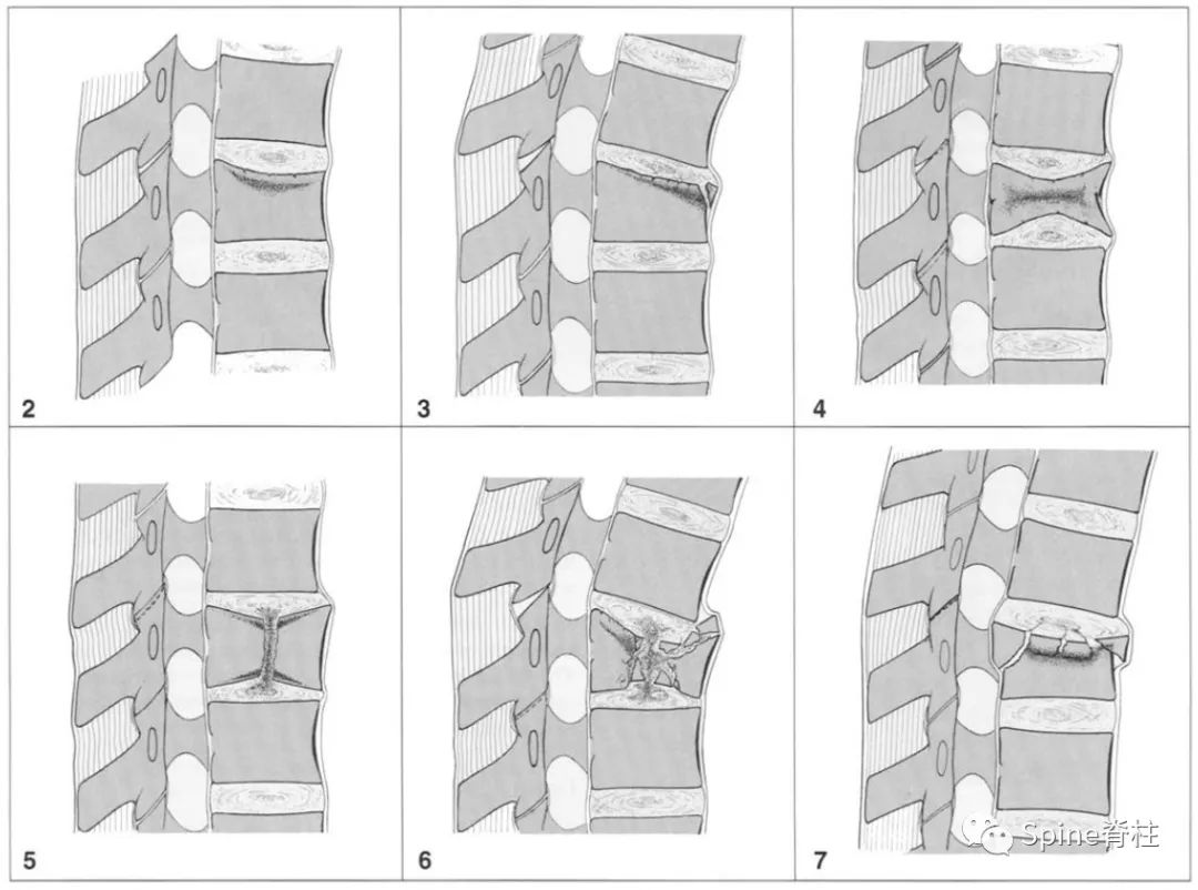 实用骨科基础:胸腰椎骨折的分型与评分,速看!