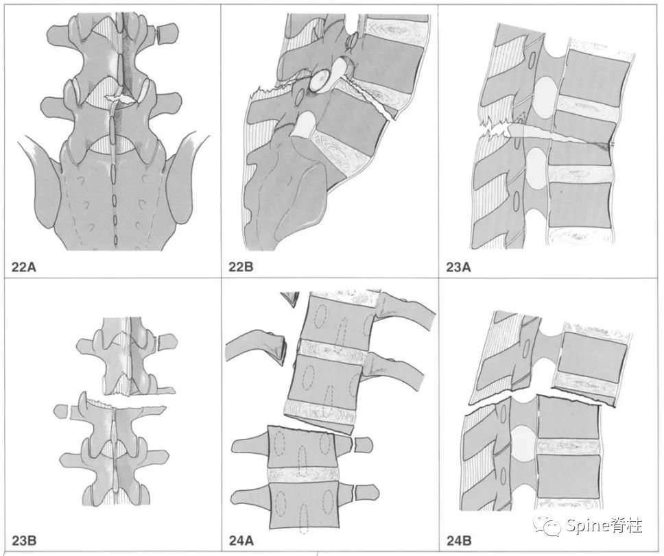 实用骨科基础：胸腰椎骨折的分型与评分，速看！